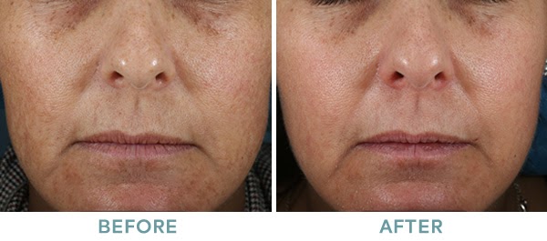 Brightening Peel Level 2 Chemical Peel Before After 01 061020 1