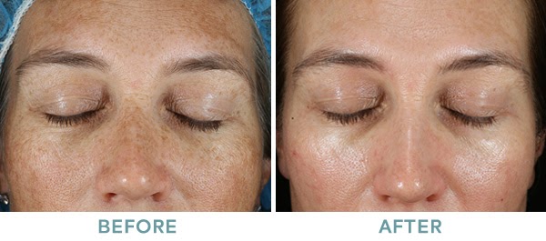 Brightening Peel Level 2 Chemical Peel Before After 02 061020 1