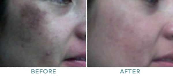 Chemical Peel Obagi Melasma Before After