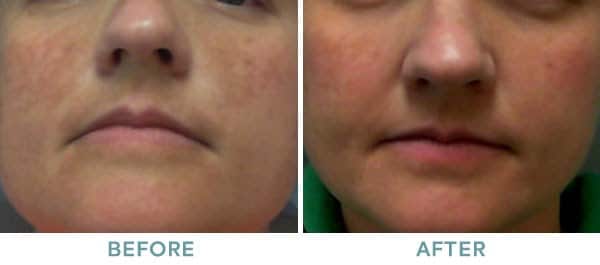 Chemical Peel TCA Before After 01