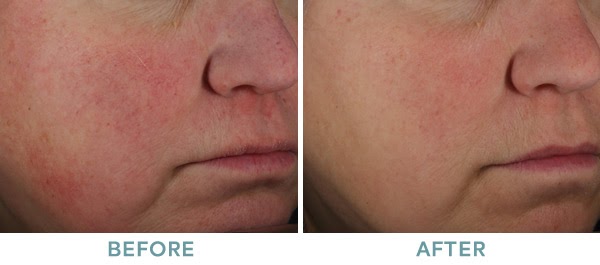 IPL LimeLight Excel Photorejuventation Rosacea Before After 01
