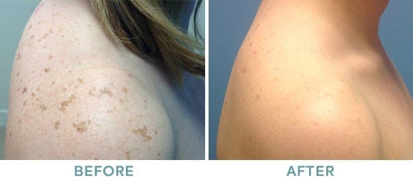 IPL Limelight Harmony Brown Spots Before After 01
