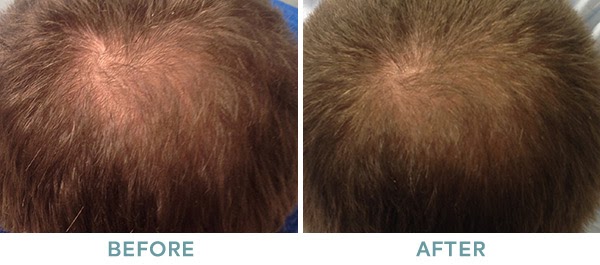 PRP Hair Restoration Before After 02