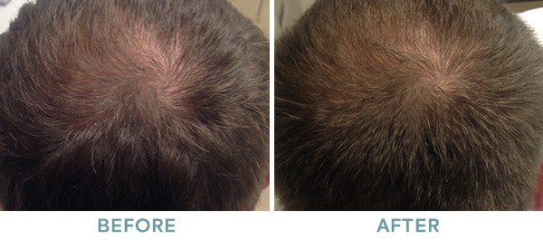 PRP Hair Restoration Before After 03