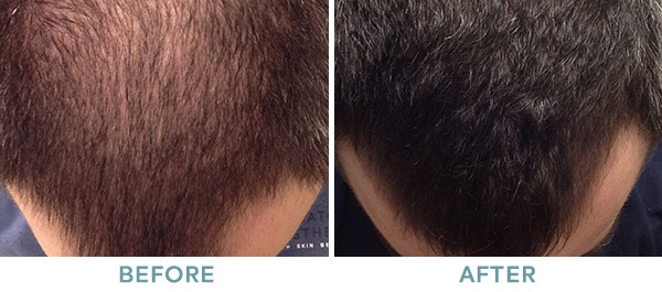 PRP Hair Restoration Before After 04