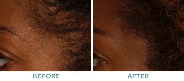 PRP Injections Alopecia Before After 01