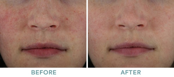 Rosecea Before After IPL VariLite 01