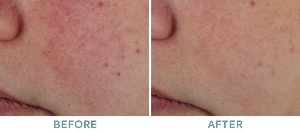 Rosecea Before After IPL VariLite 02