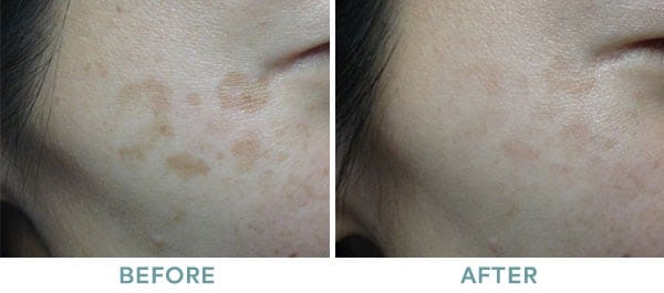 VariLite Brown Spots Before After 01