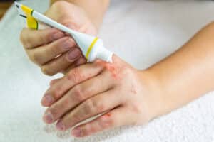 woman applying exzema ointment