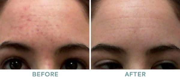Chemical Peel Acne Before After 02