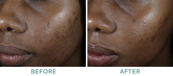 Chemical Peels - Vitalskin Dermatology