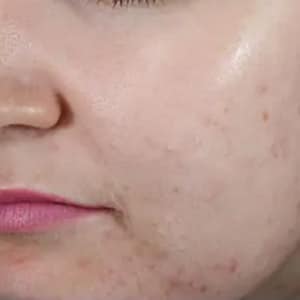 acne 2 before