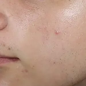 acne 4 after