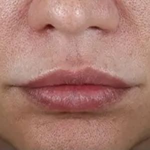 injectable dermal fillers lips 1 after