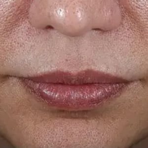 injectable dermal fillers lips 1 before