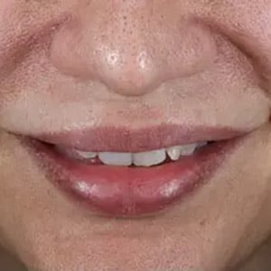 injectable dermal fillers lips 2 after