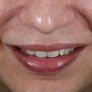 injectable dermal fillers lips 2 before