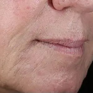 injectable dermal fillers lower face 1 after