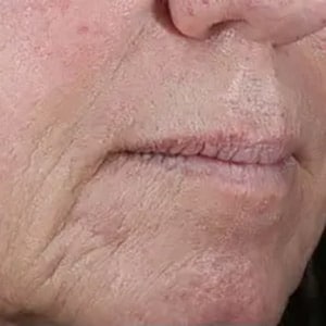 injectable dermal fillers lower face 1 before