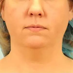 kybella 1 before