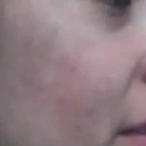 melasma 1 after