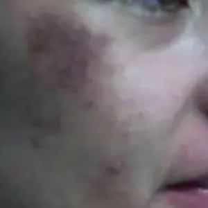 melasma 1 before