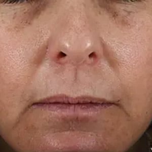 melasma 2 after