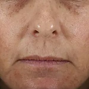 melasma 2 before