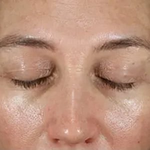 melasma 3 after