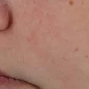 rosacea 2 after