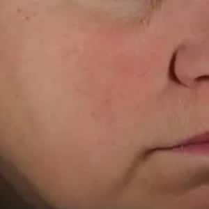 rosacea 3 after