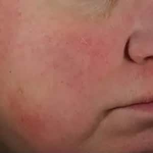 rosacea 3 before