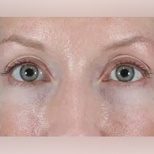 skin tightening pelleve eyes 1 after