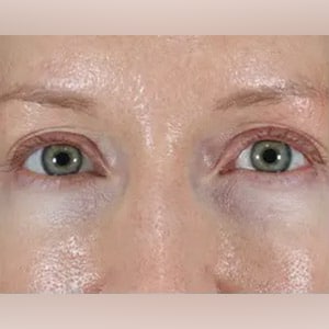 skin tightening pelleve eyes 1 before