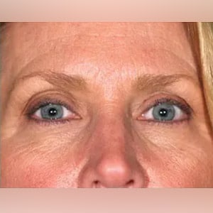 skin tightening pelleve eyes 2 after