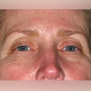 skin tightening pelleve eyes 2 before