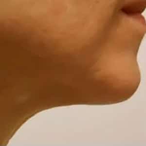 skin tightening vshape neck after