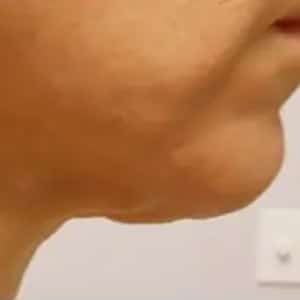 skin tightening vshape neck before