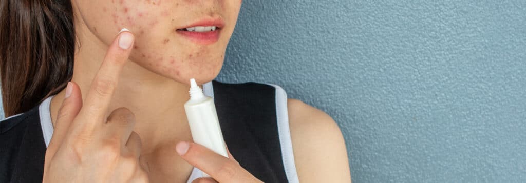 tretinoin