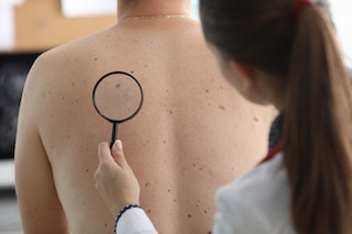 dermatologist examining moles