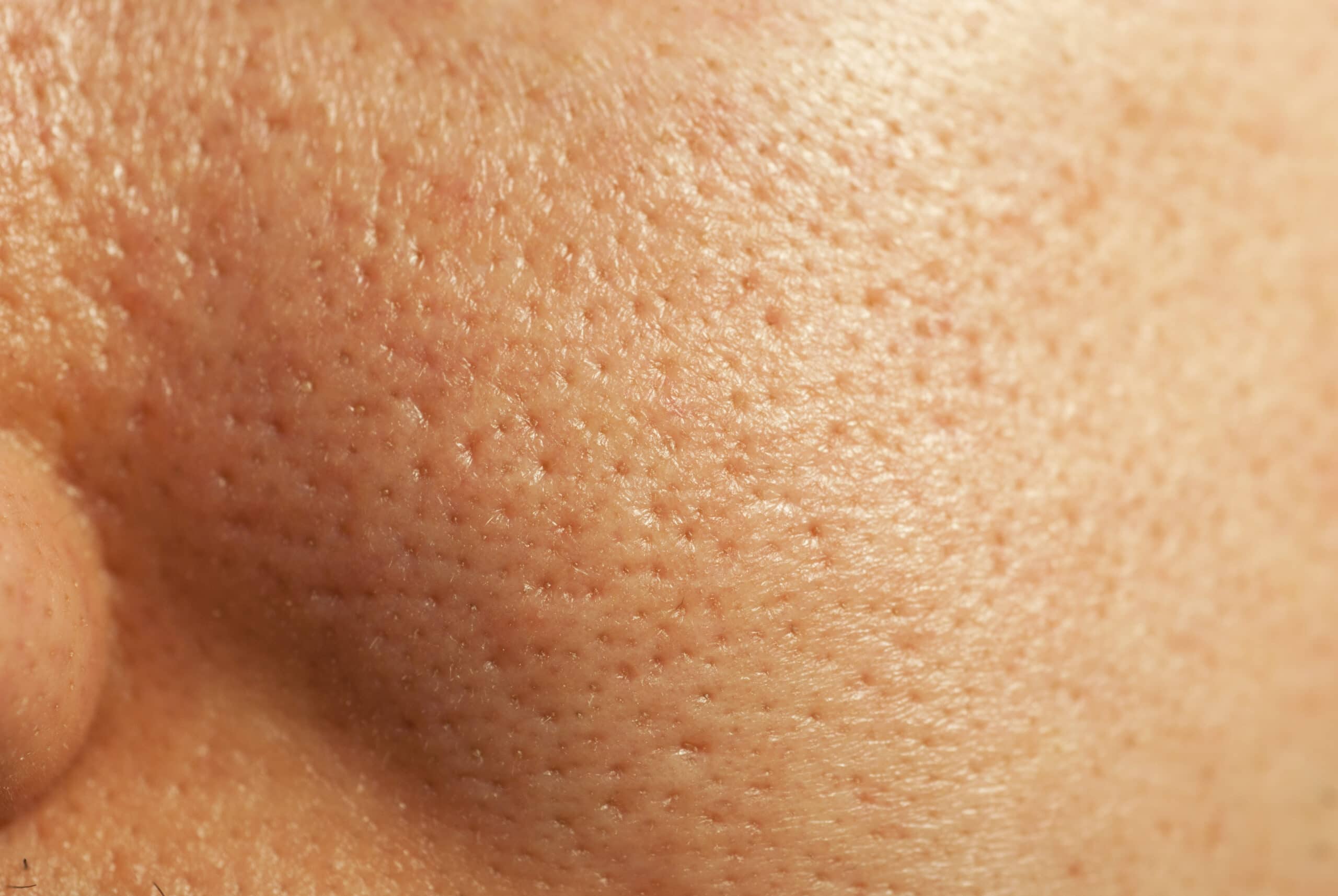 Dilated Pores VitalSkin Dermatology