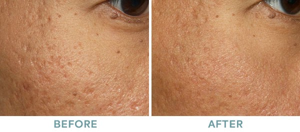 Scars | VitalSkin Dermatology