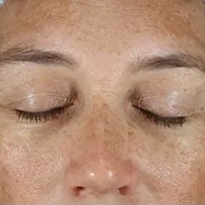 brightening peels 2 before