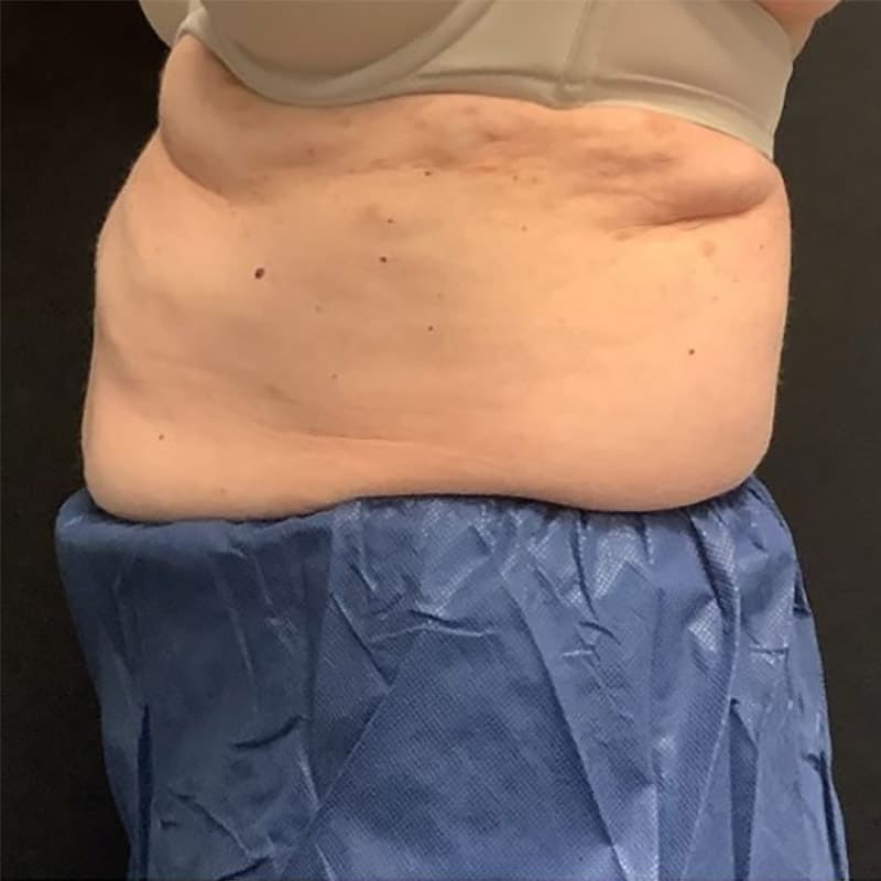 coolsculpting 1 after