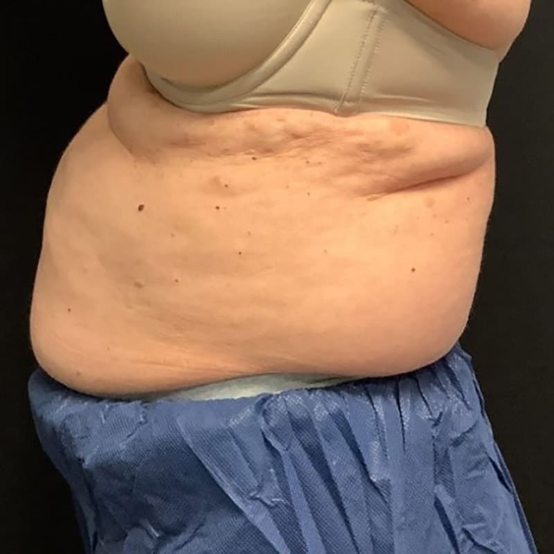 coolsculpting 1 before