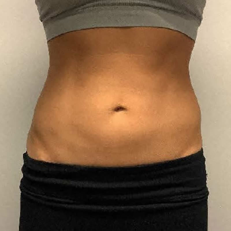 coolsculpting 2 after