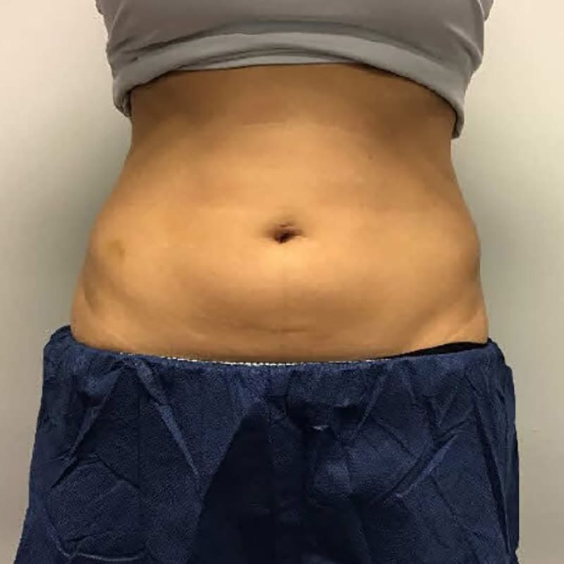 coolsculpting 2 before