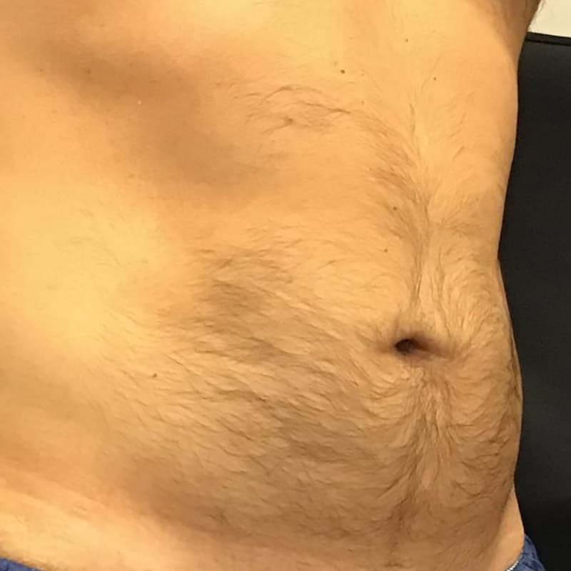 coolsculpting 3 after