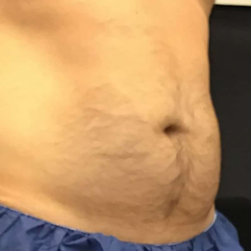 coolsculpting 3 before